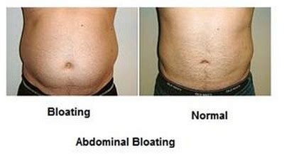 excessive bloating  burpingbelching   treatment