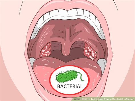 viral vs bacterial throat infection gue viral