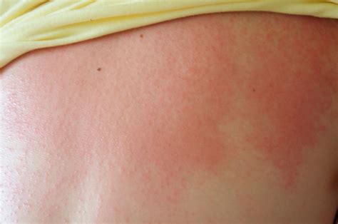 heat rash  symptoms treatments heat rash rash  heat riset