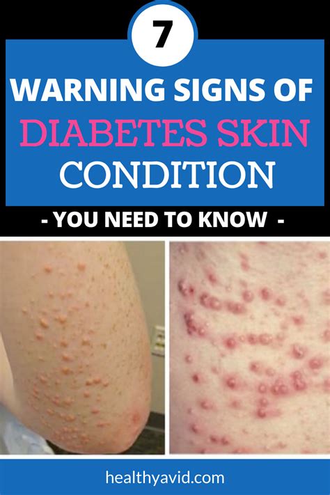 diabetes skin problems  warning signs