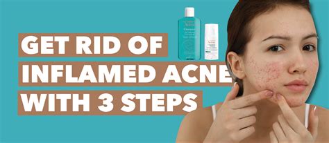 inflamed acne   swelling pain redness discomfort distress