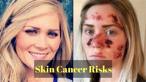 Tanning Beds And Skin Cancer Risks Youtube