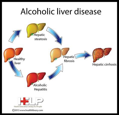 Alcoholic Liver Disease Liver Disease Nursing Information Disease