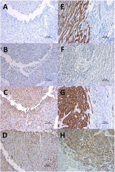 maxillary sinus carcinoma  metastatic hepatic carcinoma stained