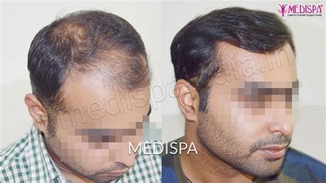 At What Age Hereditary Baldness Is Shown In Men Medispa India