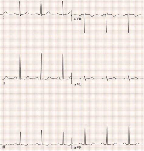 sinus rhythm thoracic key