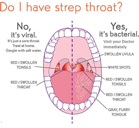 strep throat     tongue