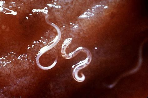 roundworms nematode infection types symptoms treatment