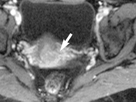 mr imaging of cervical carcinoma a practical staging approach