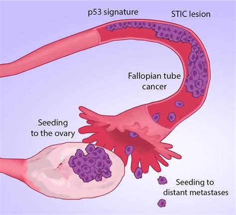 scientists track ovarian cancers  site  origin fallopian tubes
