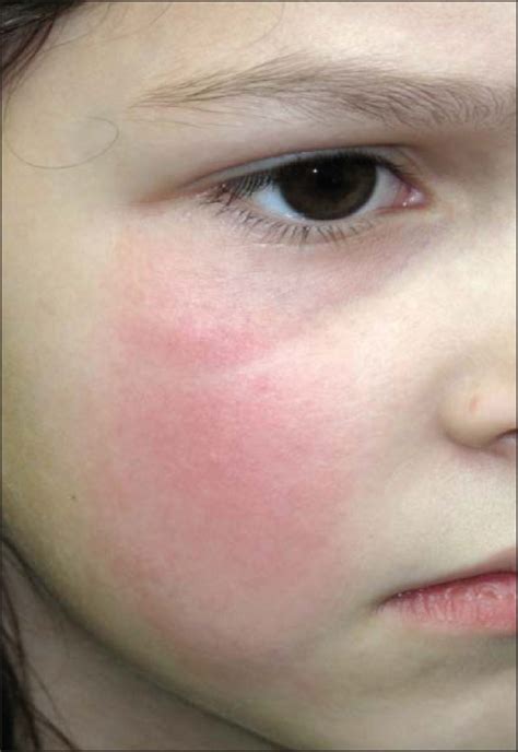 the many faces of facial cellulitis