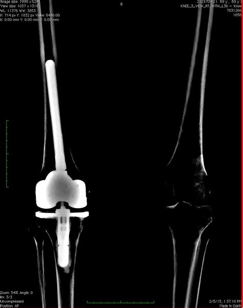 tkr total knee replacement  zimmer model lcck  legs flickr
