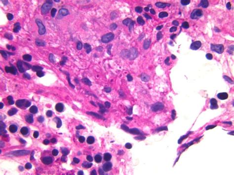 Disseminated Histoplasmosis With Bone Marrow Infiltration And Secondary