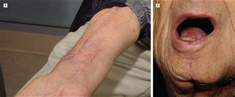 Hinged Forearm Split Thickness Skin Graft For Radial Artery