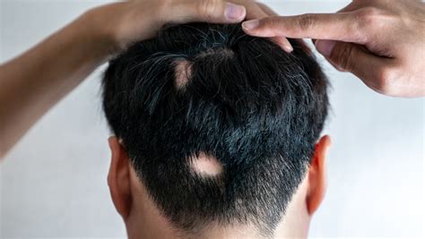 means   hair loss  patchy