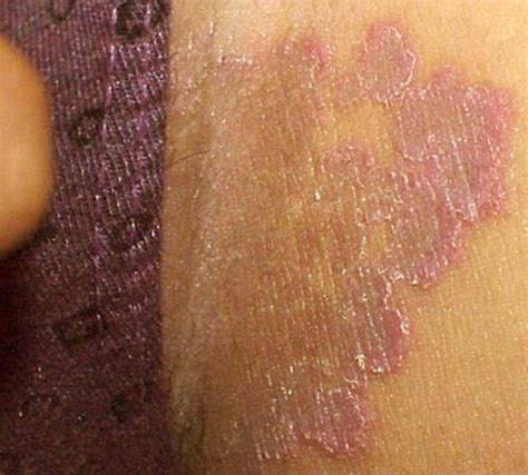 Rash On Inner Thighs Causes Pictures And Treatment Inner Thigh