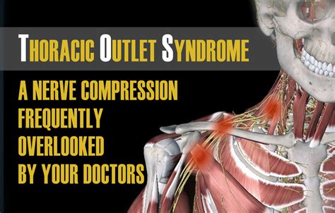Thoracic Outlet Syndrome Chiropractor In Holland