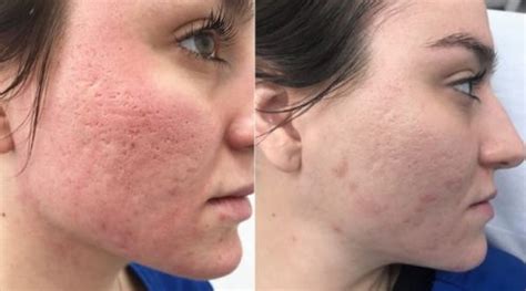 How Do The Most Effective Types Of Acne Scar Treatment In