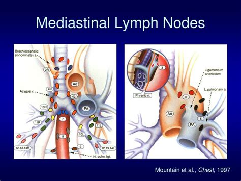 Stage 2 Cancer Lymph Nodes