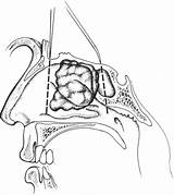 Resection Transcranial Paranasal Tumors Nasal Sinuses Cavity sketch template