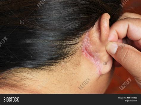 wound  ear image photo  trial bigstock