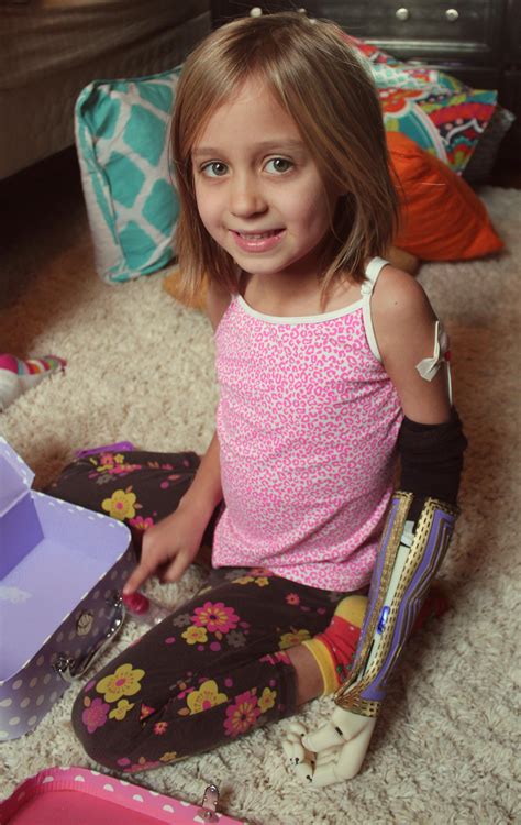 Holiday Miracle 3d Printed Myoelectric Arm Allows Girl Free Download
