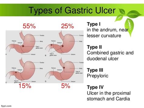 types of stomach ulcers pictures to pin on pinterest