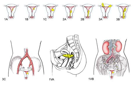 Pathology Outlines Staging Carcinoma And Carcinosarcoma