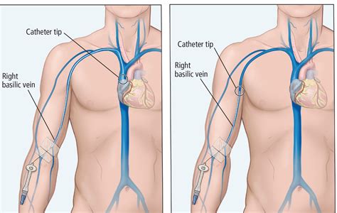 can i place a peripherally inserted central catheter in my patient with