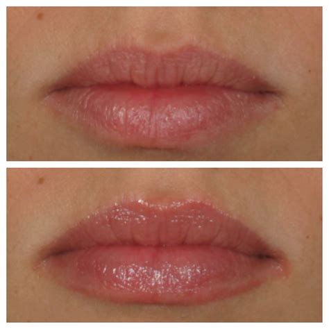 lip plumping   minutes lip benefits   premier laser day spa