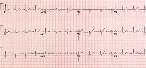 Analysis And Interpretation Of The Electrocardiogram