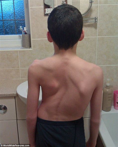 teenager with scoliosis grows five inches overnight after operation to