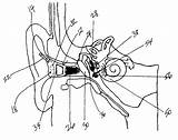 Implant Cochlear Patents sketch template