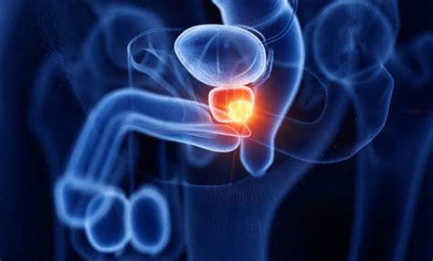 prostate cancer affects men  india  advancements  diagnosis