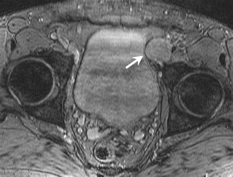 imaging of penile neoplasms radiographics