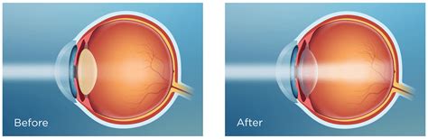 preserve  rejuvenated vision  cataract surgery