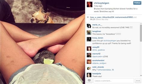 stretchies say hi chrissy teigen shows off her stretch marks and bruises on social media