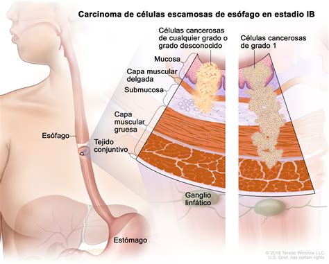 tratamiento del cáncer de esófago en adultos pdq® versión para