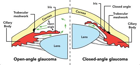 viagra angle closure glaucoma medications  avoid  glaucoma