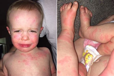 Scarlet Fever Is On The Rise In Parts Of Uk Here Is What To Look Out