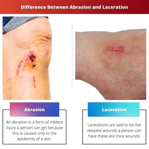 abrasion  laceration difference  comparison