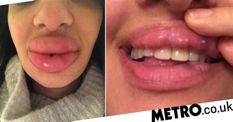 Botched Lip Fillers Left Woman With Rock Hard Blue Lumps On Her Mouth