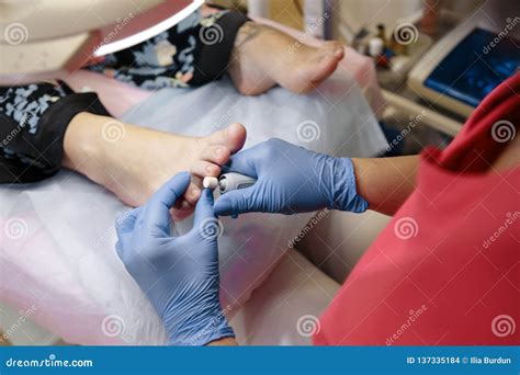 podiatrist treating toenail fungus stock photo image  mycosis foot