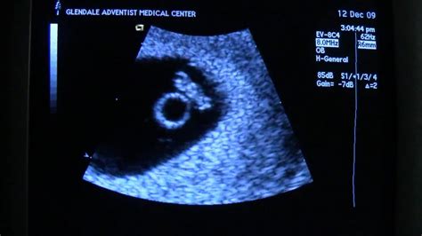 ultrasound 6 weeks 6 days heartbeat youtube