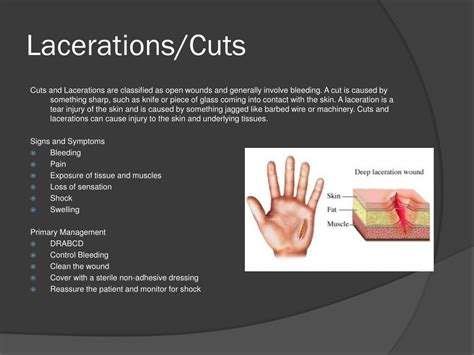 cutslacerations  fractures powerpoint
