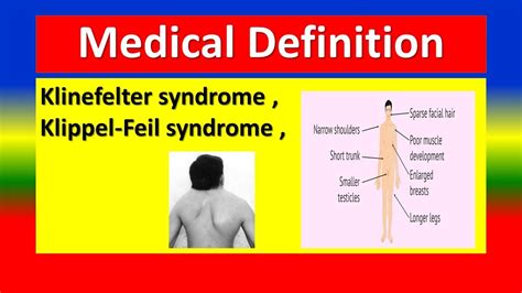 Klinefelter Syndrome Klippel Feil Syndrome Medical Definition Youtube