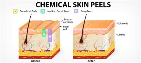 chemische peeling  den haag wat  dat nou eigenlijk mourits huidtherapie