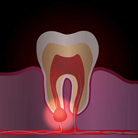 tooth nerve pain   treatments