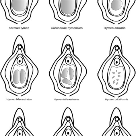 Shows Some Of The Different Configurations Of The Hymen Download