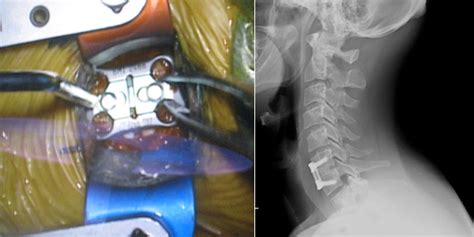 Anterior Cervical Discectomy And Fusion Boulder